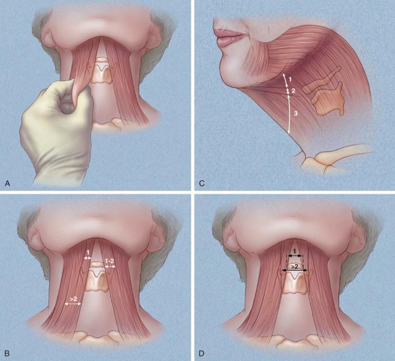 FIGURE 13.2, Clinical assessment of platysma muscles. (A) How thick are the platysma bands? (B) How wide are the platysma bands? (C) How far do the platysma bands descend? (D) How wide apart are the platysma bands?