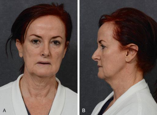 FIGURE 13.3, TR, a 56-year old woman. (A) Preoperative view, anteroposterior. (B) Preoperative view, left lateral.