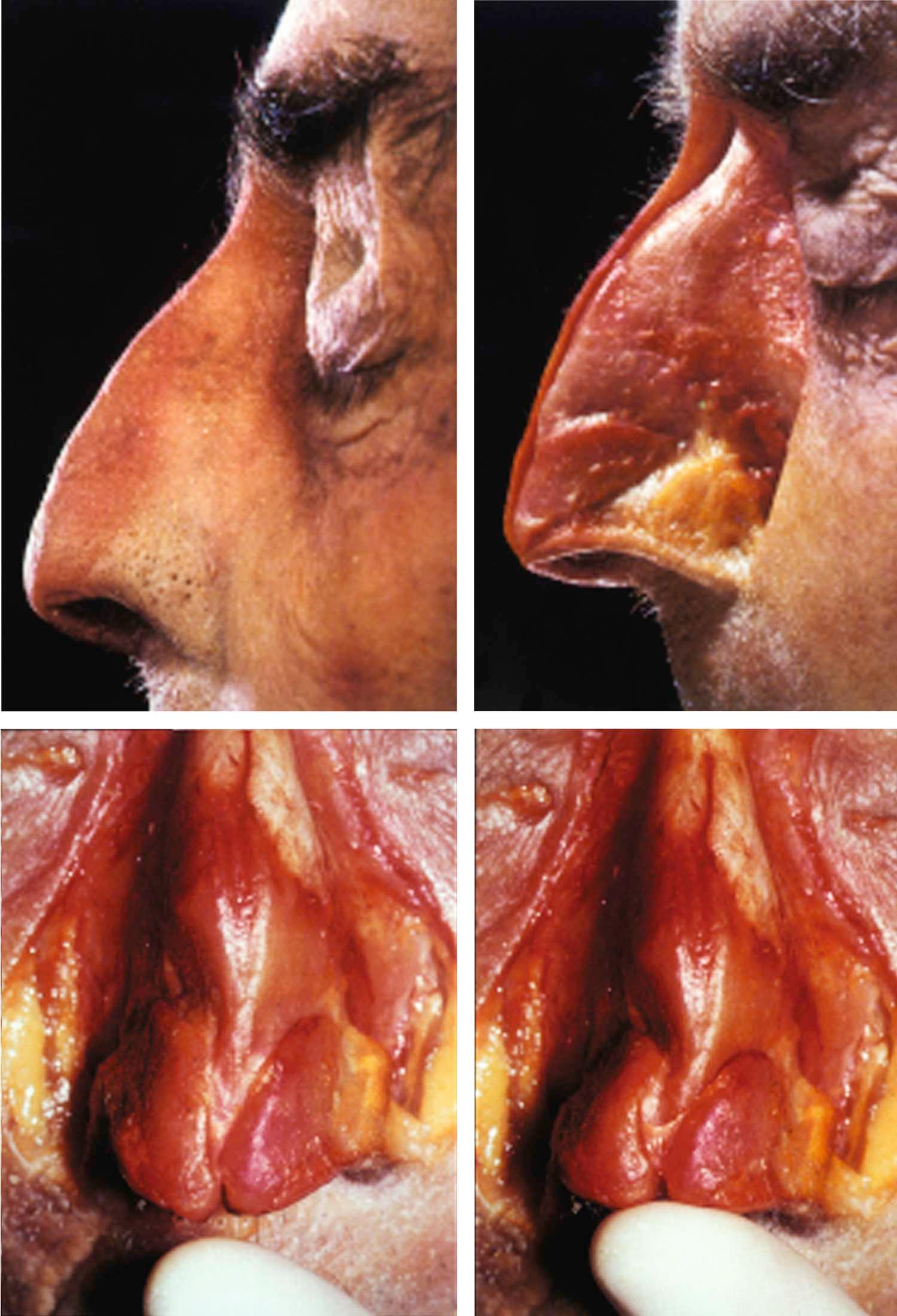 Figure 25-1, Anatomy of the nose. The nasal tip is a dynamic structure, hinged by the upper lateral cartilages and by the recurvature of the lower lateral cartilages.