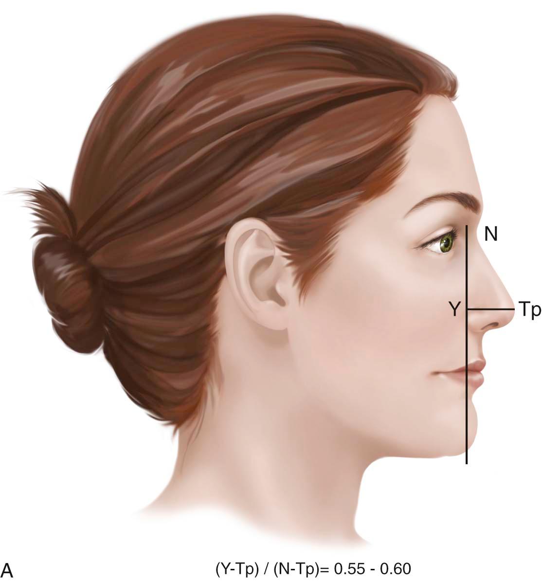 Figure 25-3, A, The Goode method defines ideal nasal tip projection as a ratio of 0.55 to 0.6 of the distance from the nasion to the tip-defining points. B, With Simons method, tip projection (Sn–Tp) should equal the height of the upper lip (Sn–Vs). C, Crumley and Lanser described a right triangle with dimensions corresponding to nasal proportions; ideally projection : height : length is equal to 3 : 4 : 5. D, Powell and Humphries defined the ideal relationship between tip projection and nasal height as a 2.8 : 1 ratio.