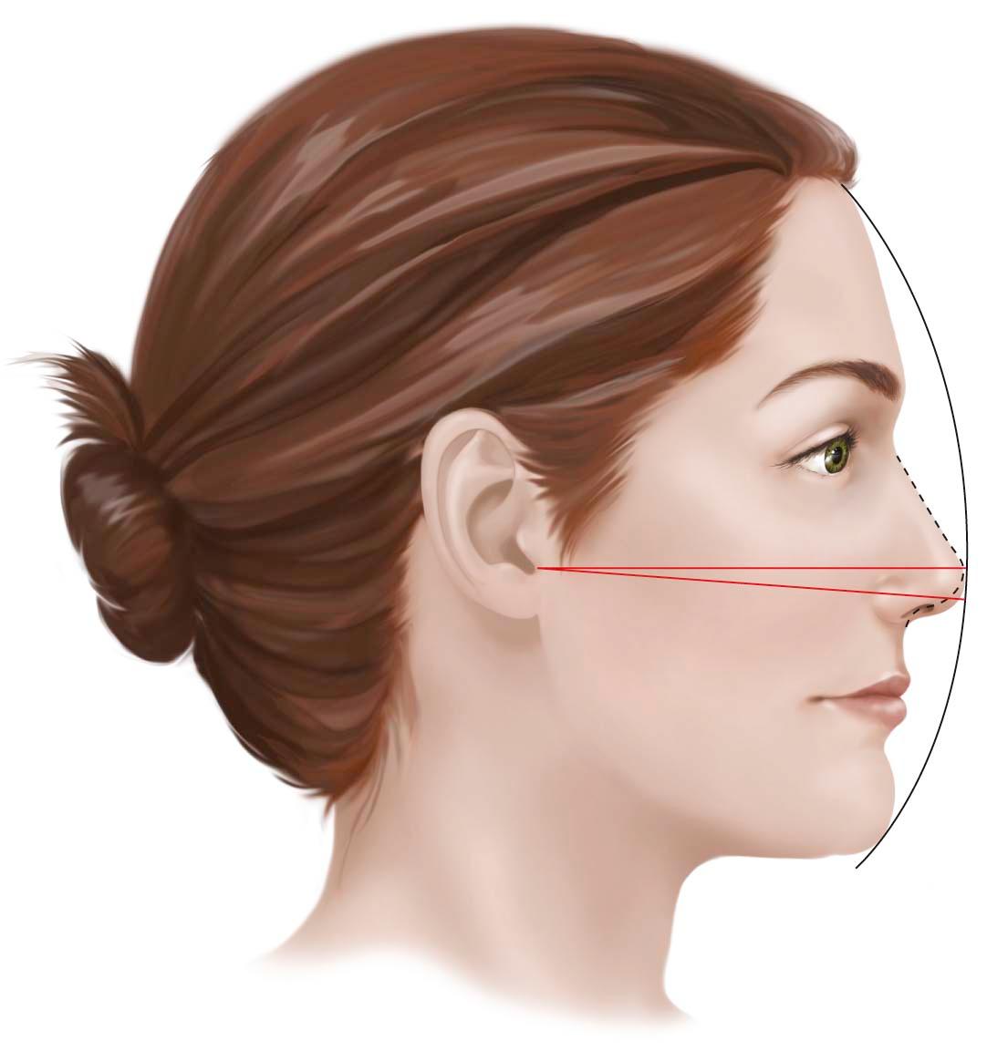 Figure 25-4, Nasal tip rotation is defined as movement of the nasal tip along an arc with constant distance from the facial plane.