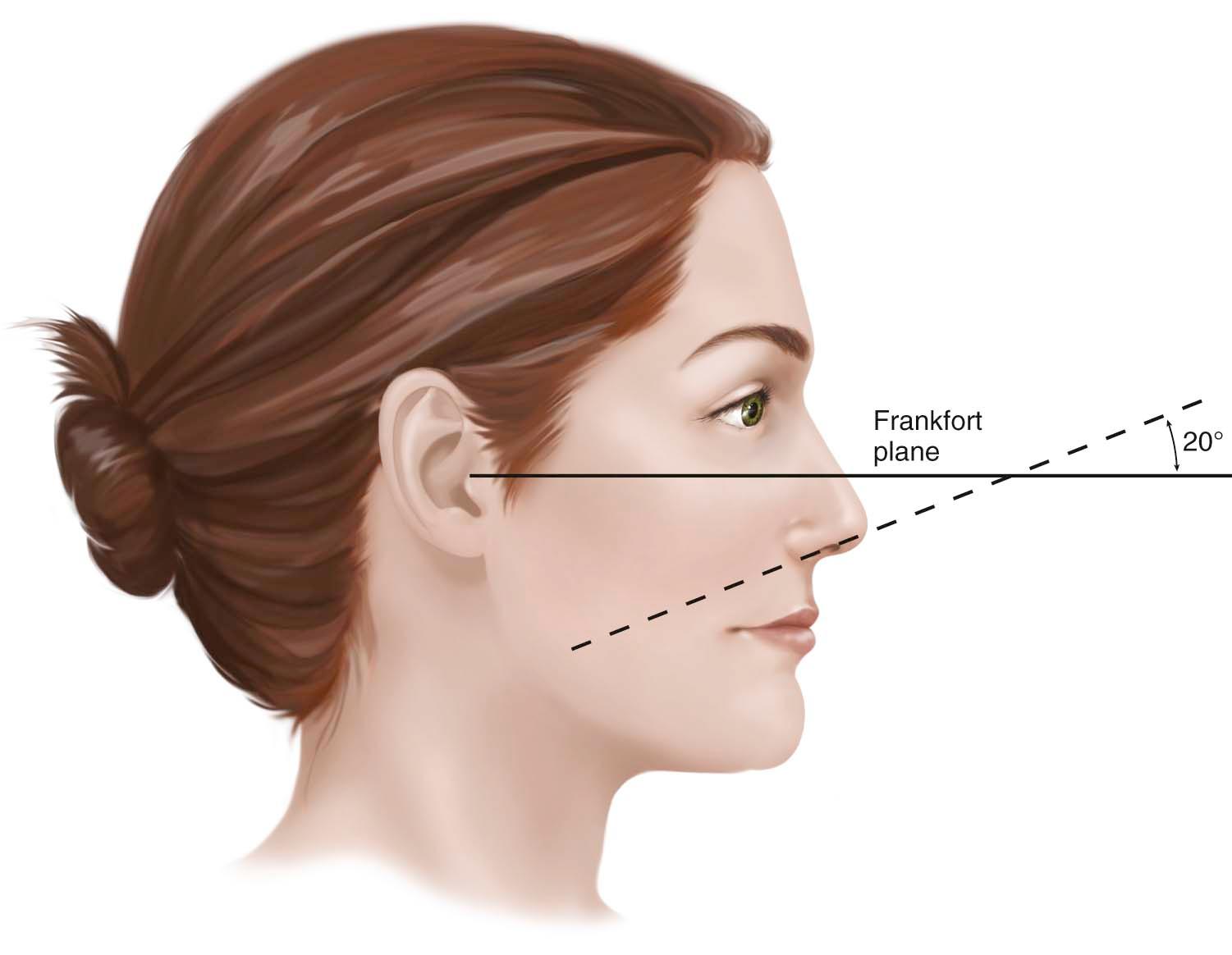 Figure 25-5, The degree of tip rotation is measured with reference to the Frankfort plane and the long axis of the nostril.