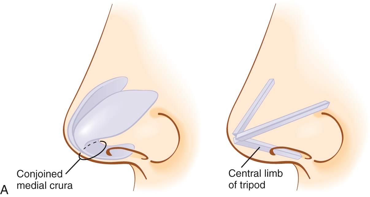 Figure 25-7, A, Tripod theory. The upper tripod legs are formed by the lateral crural complex and the lower tripod leg is formed by the conjoined medial crura. B, Here, shortening of the upper legs leads to movement of the tip of the tripod upward and slightly posteriorly, effectively increasing nasal tip rotation without a significant effect on tip projection. C, Lengthening the lower tripod leg increases both tip rotation and projection.