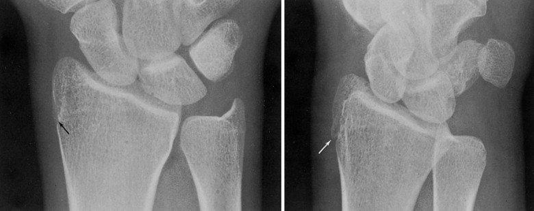 FIGURE 6-135, Remnants of the epiphyseal line in a 20-year-old man.