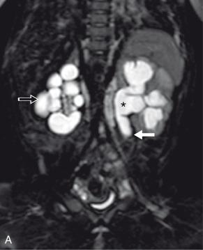 Figure 118.1, Left ureteral valve in a 2-month-old girl.