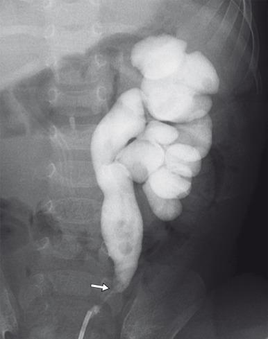 Figure 118.3, Left congenital ureteral stricture in a 5-month-old girl.