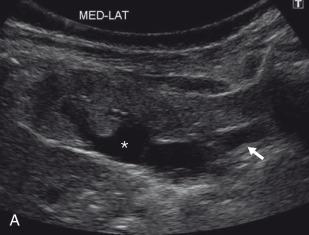 e-Figure 118.4, Right congenital ureteral stricture and solitary right kidney in a 1-month-old girl.