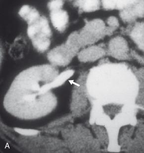 e-Figure 118.5, Sequential cranial to caudal axial images of a retrocaval ureter on excretory phase contrast-enhanced CT.