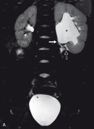 Figure 118.6, UPJ obstruction due to a crossing vessel.