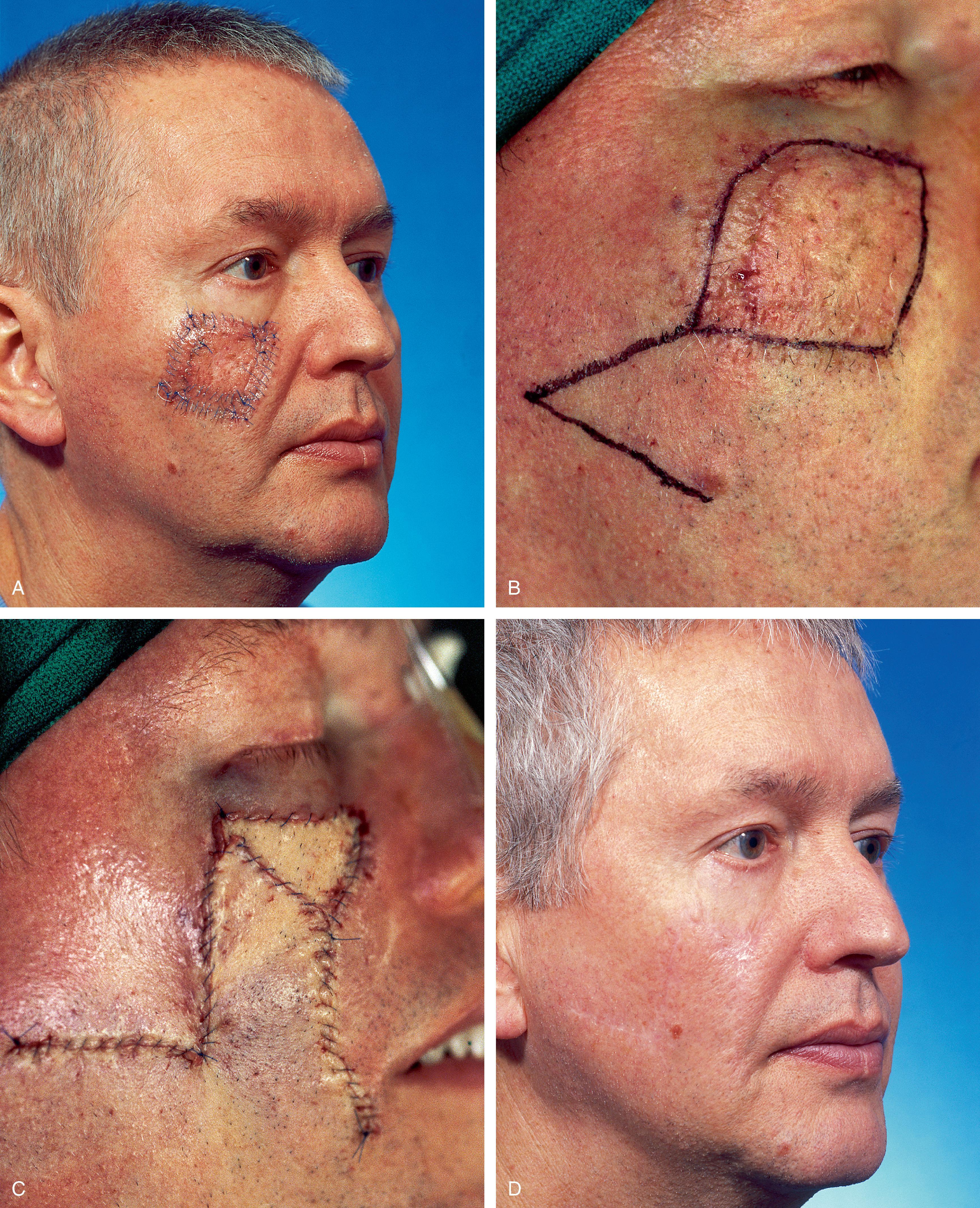 Fig. 16.1, Rhombic flap and full-thickness skin graft (FTSG). A , Atypical junctional melanocytic hyperplasia measuring 4 × 4 cm. Tumor-free margins around lesion determined by square technique. B , Inferiorly based rhombic flap designed for repair after excision of lesion. C , Transposed flap combined with 3.5 × 2 cm FTSG. Graft used to prevent downward traction on lower eyelid. Skin graft obtained from standing cutaneous deformity excised at base of flap. D . Thirteen months postoperative. No revision surgery performed.