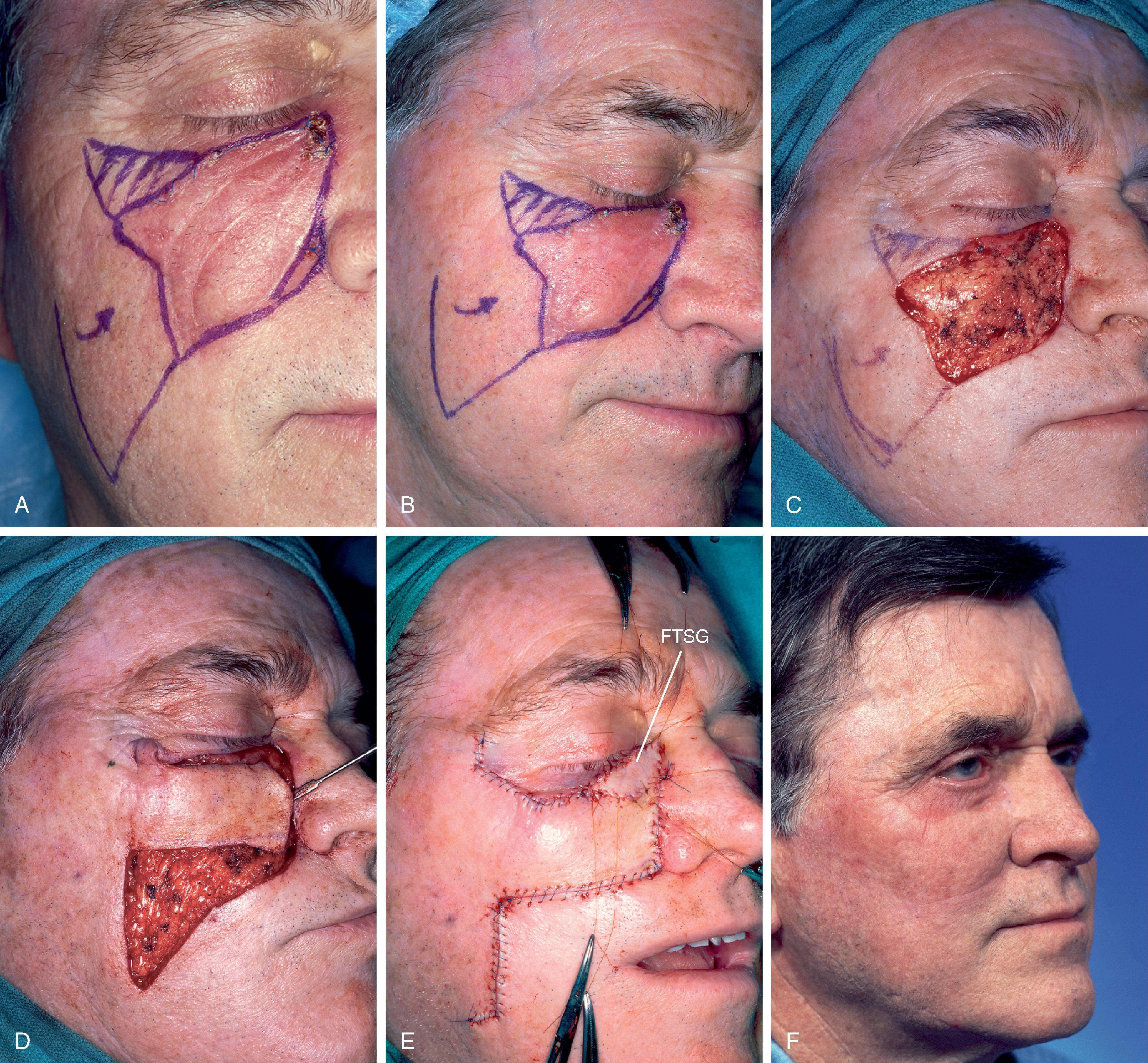 FIG. 16.2, Transposition flap and full-thickness skin graft (FTSG). A , B , A 4 × 5 cm lentigo maligna melanoma of cheek and lower eyelid. Tumor-free margins around lesion determined by square technique. Transposition flap designed for repair of cheek defect after resection of melanoma. Vertical marks indicate anticipated standing cutaneous deformity (SCD). C , D , Lesion excised and flap transposed. E , FTSG from excised SCD used to repair lower eyelid component of defect. F . Three months postoperative. Mild retraction of lower eyelid developed from partial necrosis of skin graft.