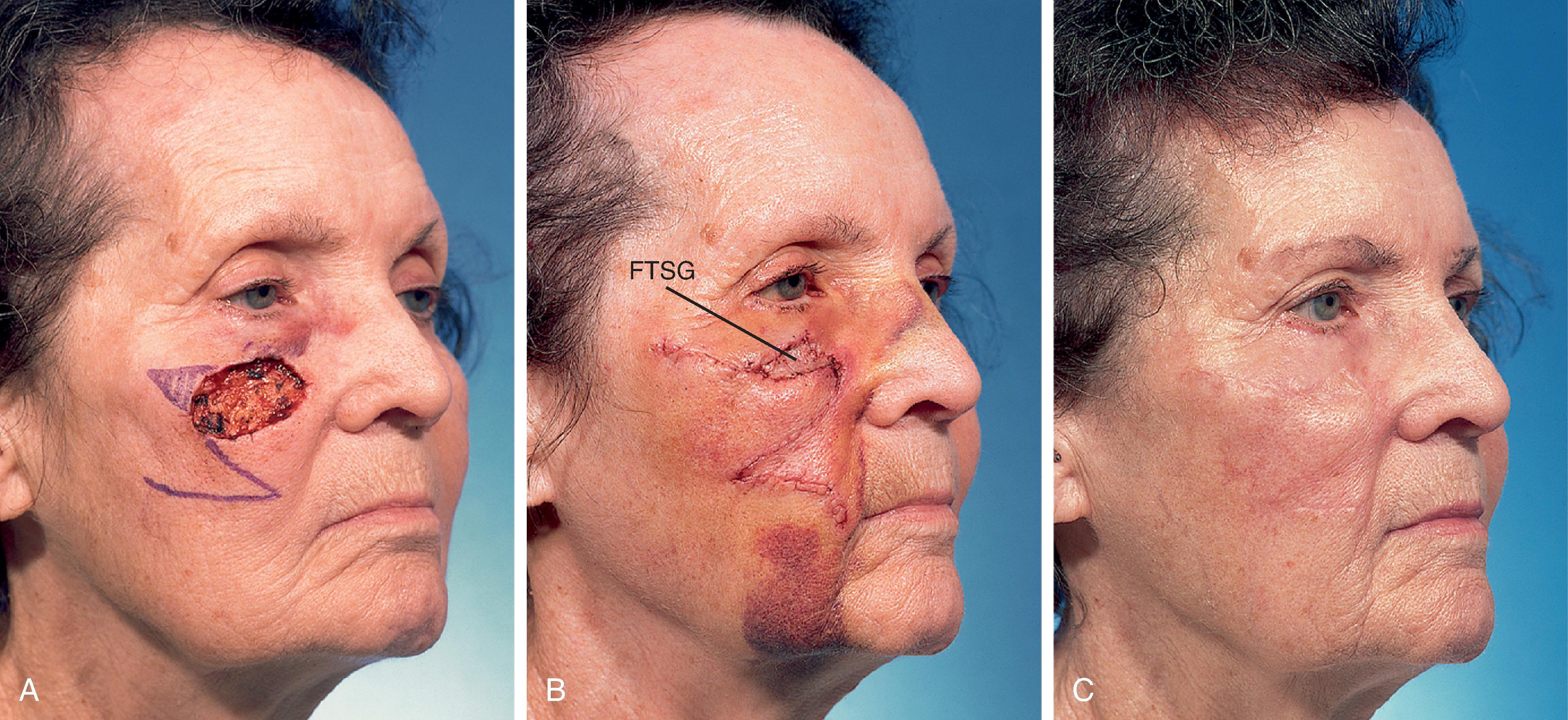 FIG. 16.3, Transposition flap and full-thickness skin graft (FTSG). A , A 5 × 1.8 cm laterally based transposition flap designed to close a 4 × 2.5 cm skin defect of cheek. Vertical marks indicate anticipated standing cutaneous deformity (SCD). B , Five days after transfer of flap combined with 2.5 × 1 cm FTSG harvested from the SCD. Graft was used to prevent lower eyelid retraction. C , Five months postoperative. No revision surgery performed.