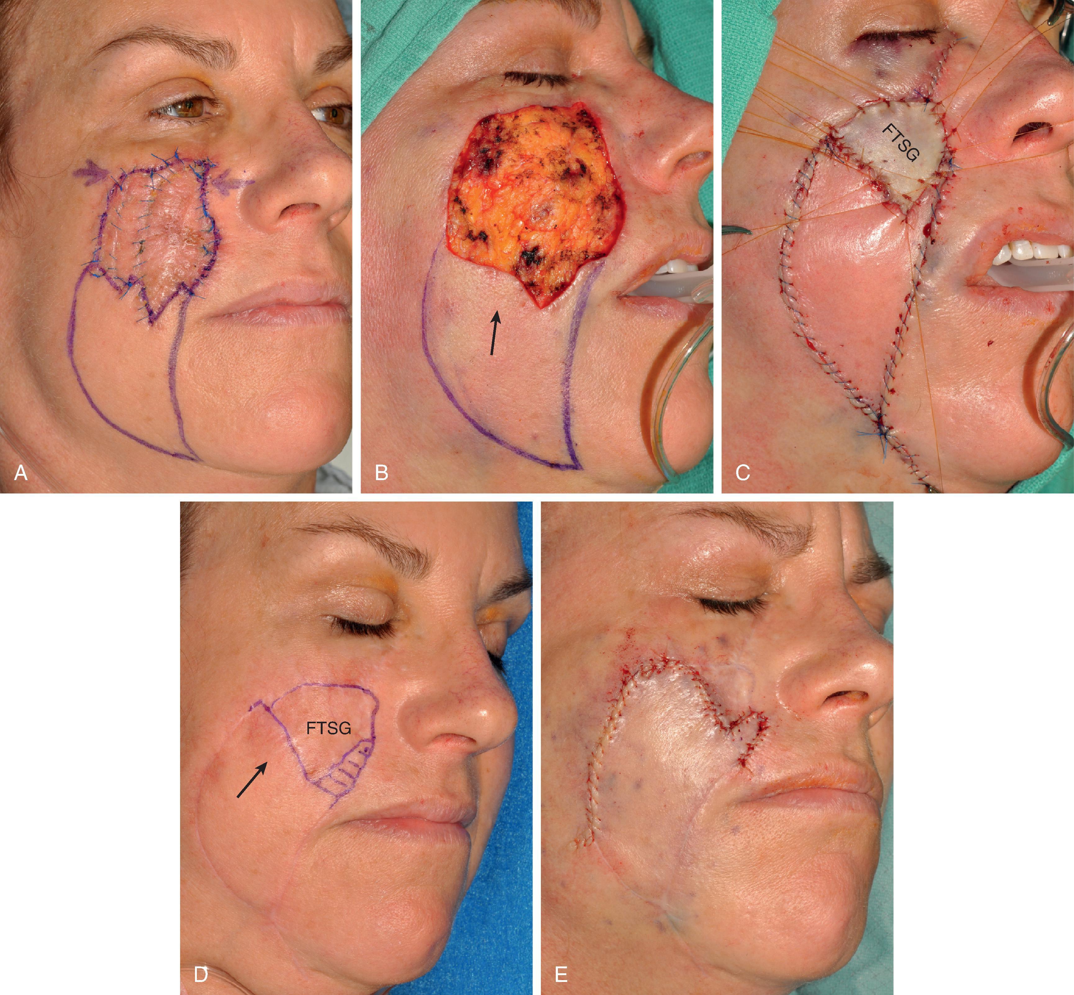 FIG. 16.4, V-to-Y subcutaneous tissue pedicled island advancement flap and skin graft A , A 5 × 3.5 cm melanoma in situ marked for excision. B . Melanoma excised. A 7 × 3.5 cm V-to-Y subcutaneous tissue pedicle advancement flap designed for repair of cutaneous defect. C , V-to-Y flap in place. A 3 × 2.5 cm full-thickness skin graft (FTSG) from supraclavicular fossa used to cover remaining portion of defect. D , Six months postoperative. Healed FTSG outlined in blue. Horizontal markings represent the superior portion of the V-to-Y advancement flap. Arrow represents direction of movement of planned cutaneous pedicled advancement flap. E , Advancement flap in place. Majority of FTSG resected and resulting defect covered by advancement flap. F-I , Before excision of melanoma and 7 months after second surgical stage. No revision surgery performed.