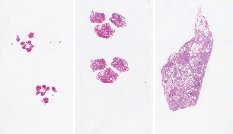 FIG. 2.1, Comparison of transbronchial, cryobiopsy, and open lung biopsy.