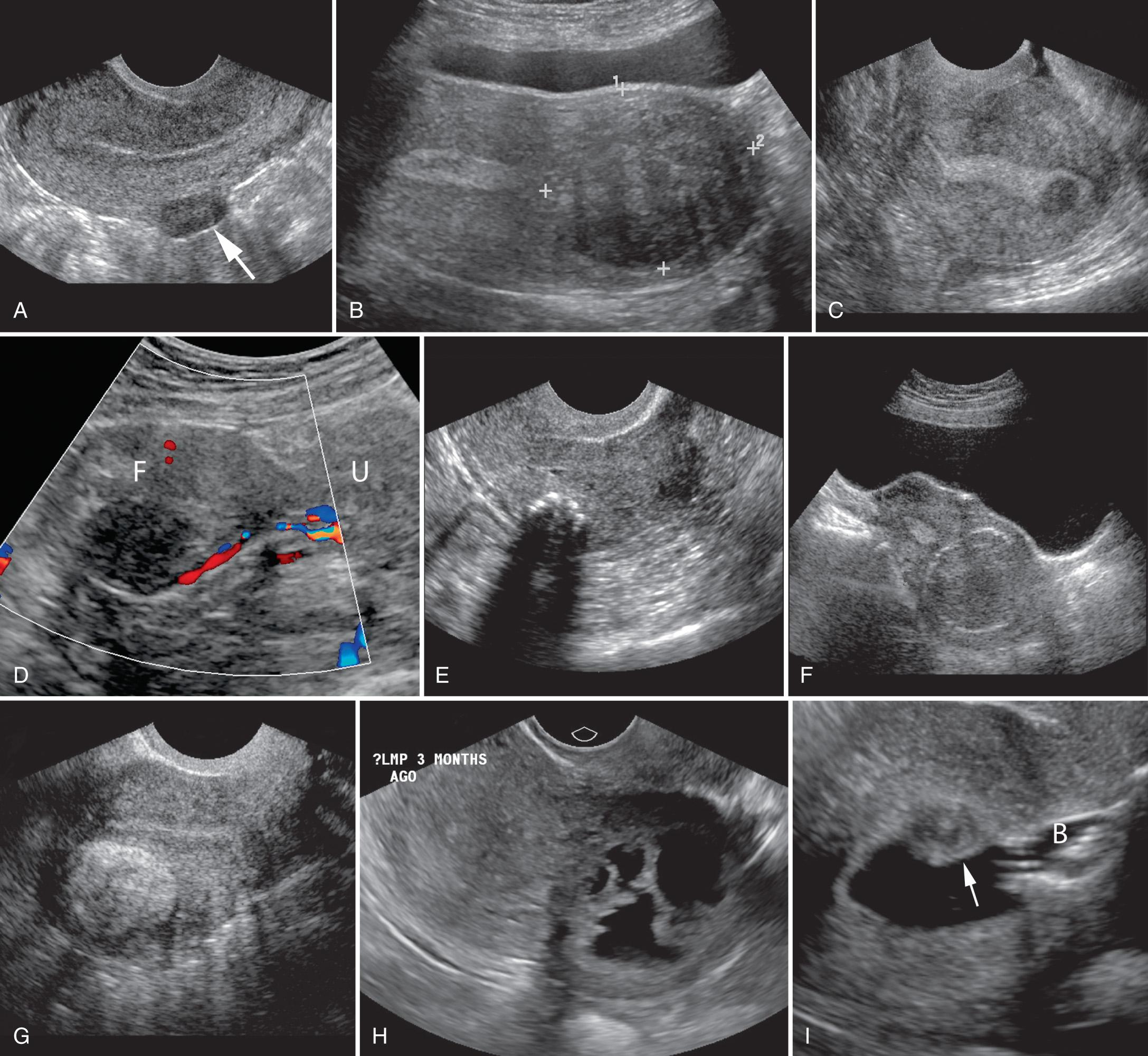 FIG. 15.11, Leiomyomas, Variable Appearances.