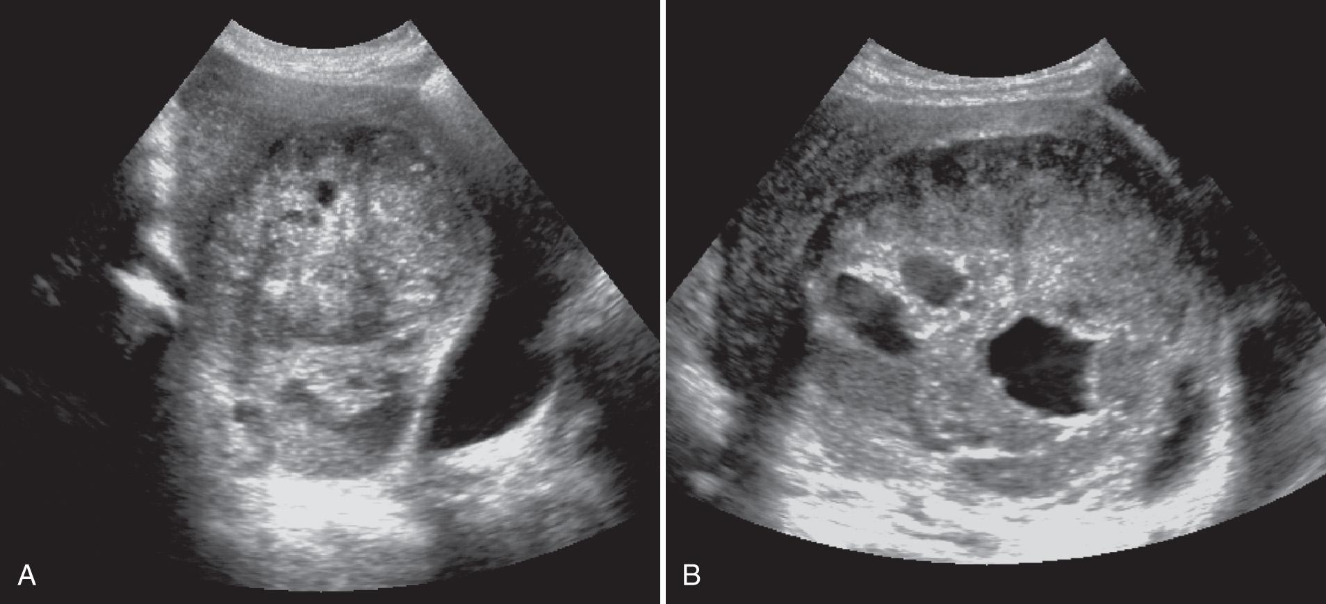 FIG. 15.12, Leiomyosarcoma.