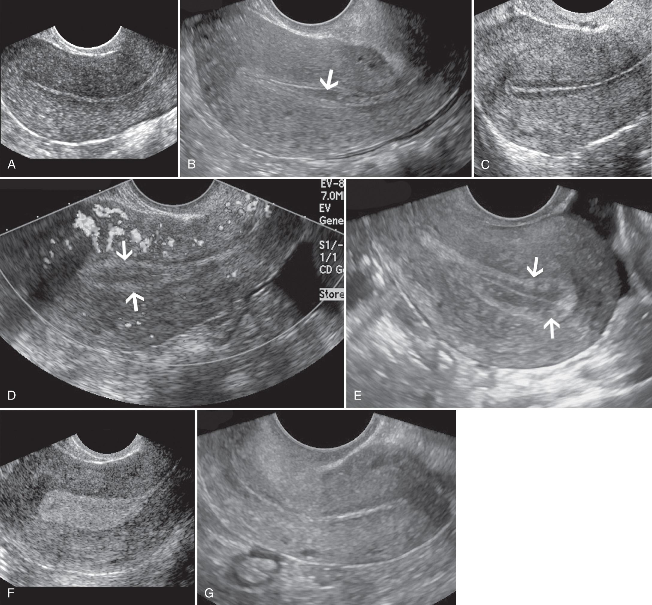 FIG. 15.3, Endometrium—Normal Appearances.