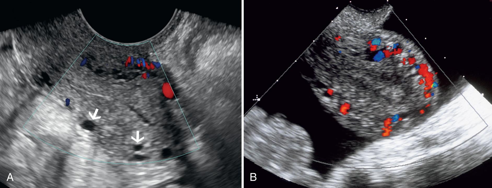 FIG. 15.4, Myometrial Veins.