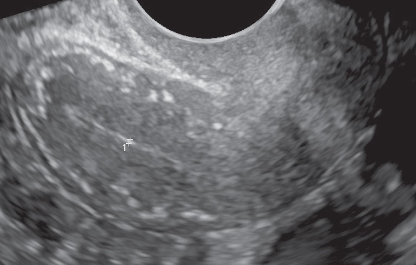 FIG. 15.5, Arcuate Artery Calcifications.