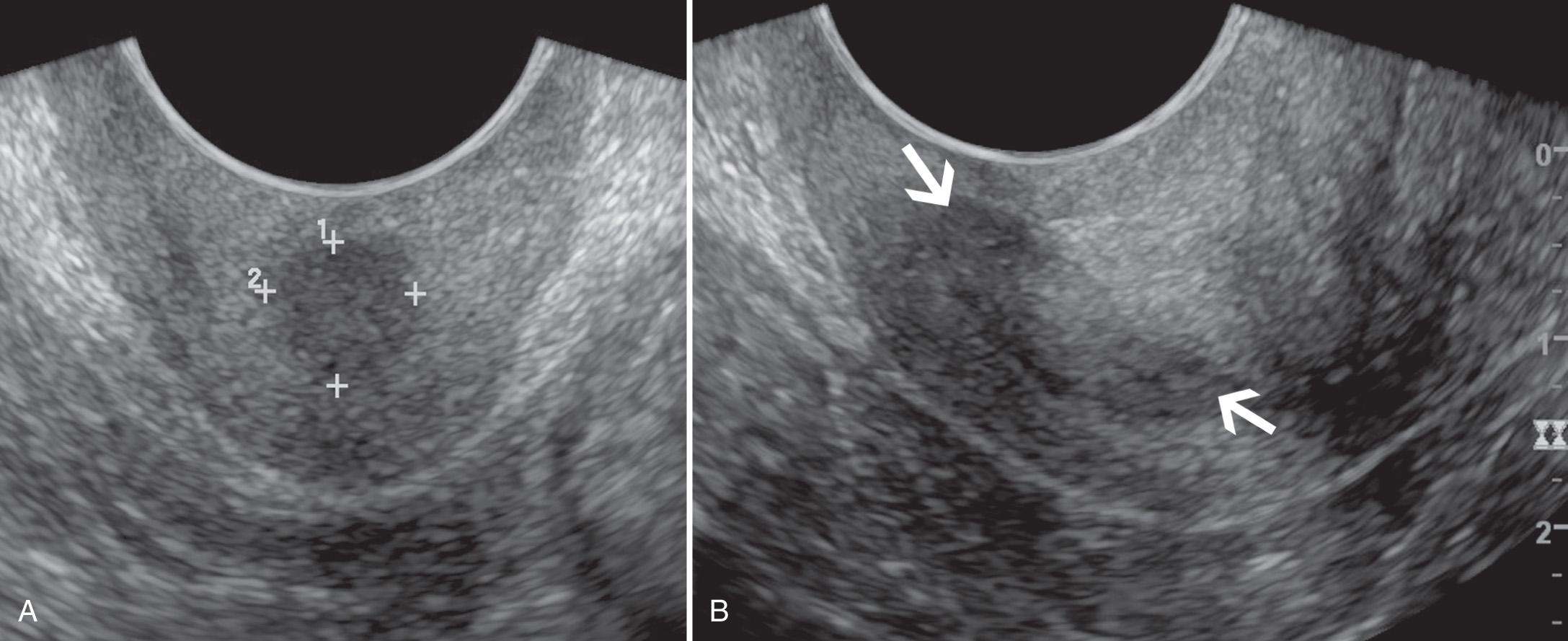 FIG. 15.8, Cervical Pseudomass.