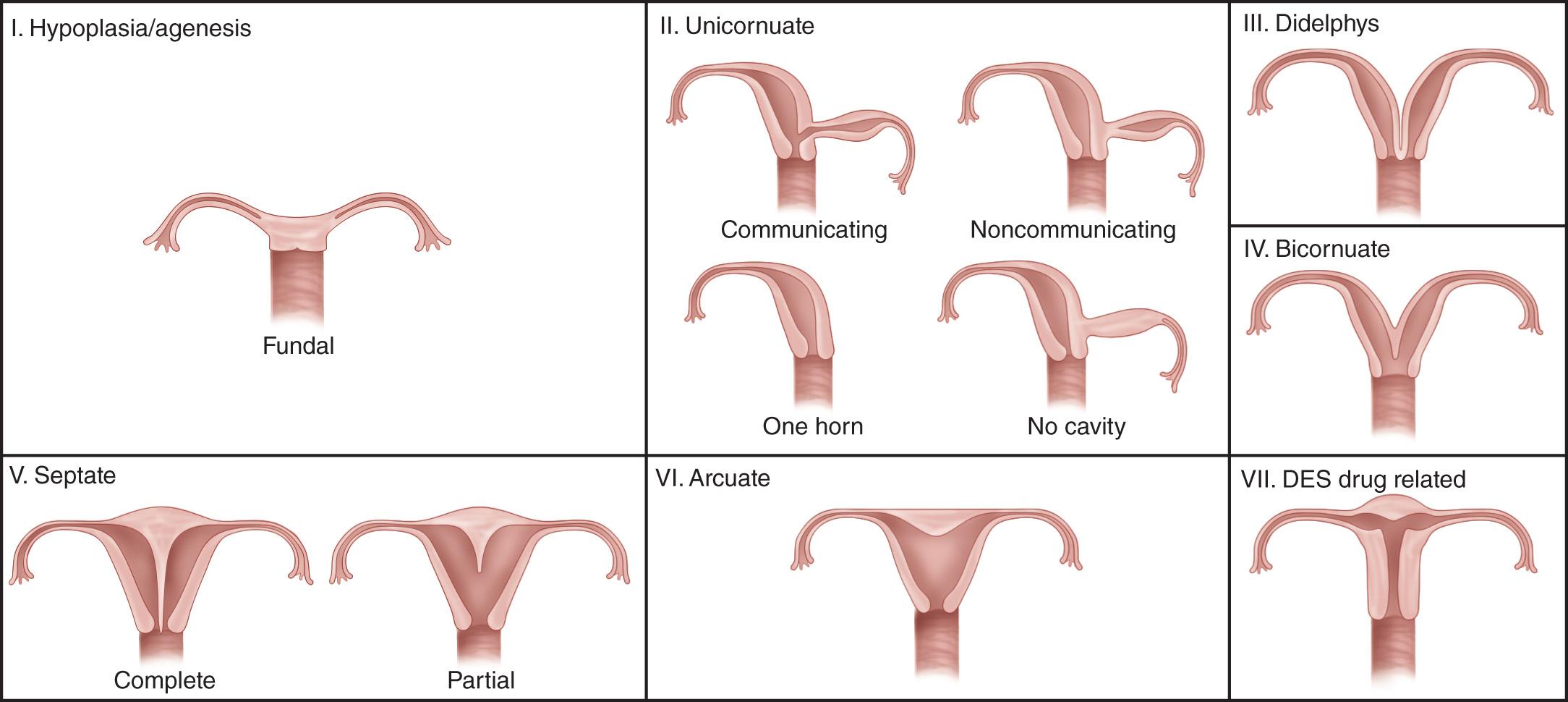 FIG. 15.9, Drawing of Müllerian Abnormalities.