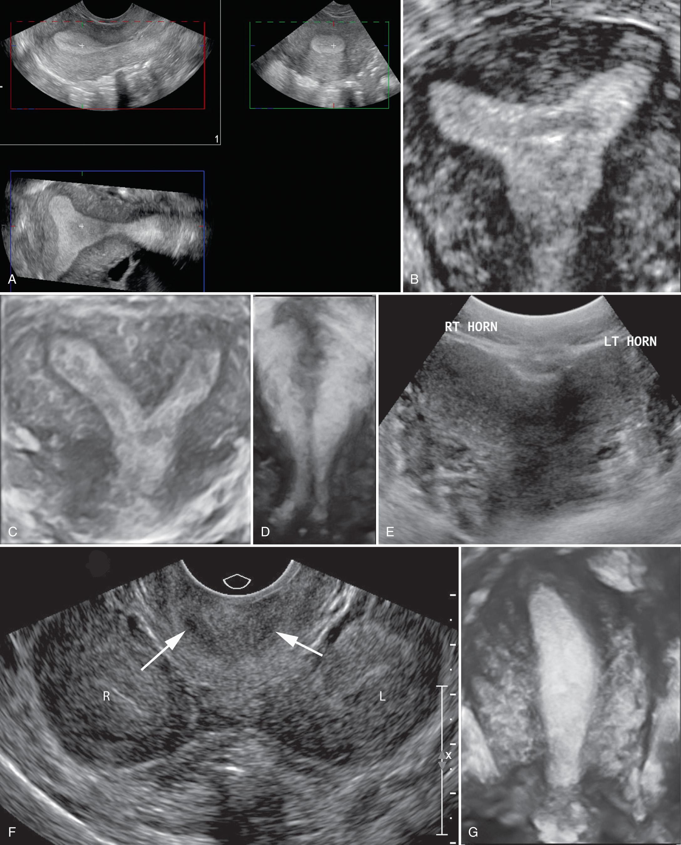 FIG. 15.10, Coronal Images of Normal Uterus and Müllerian Duct Anomalies.