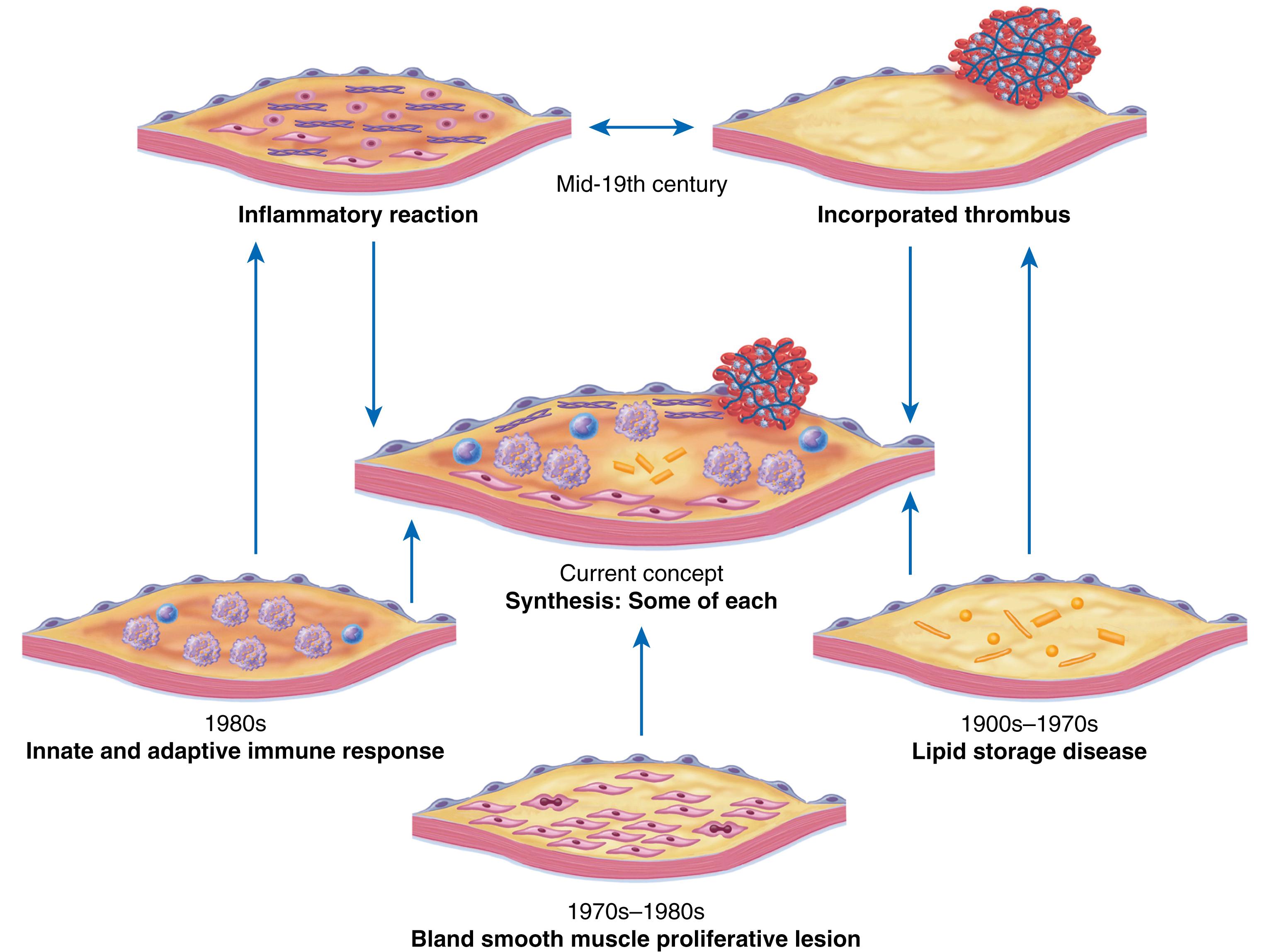 FIGURE 24.1, Evolution of concepts of the pathogenesis of atherosclerosis. The diagrams represent the dominant formulation of mechanisms of atherogenesis as they emerged over time (clockwise). In the mid-19th century, Virchow and von Rokitansky fueled a heated controversy regarding the role of incorporated thrombus in atherosclerosis (top pair of diagrams). The experiments of an Anichkov and many others lead to a predominant view of atherosclerosis as primarily a lipid storage disease. This concept prevailed for much of the 20th century. The pioneering work of Ross and of Benditt in the 1970s emphasized the role of smooth muscle proliferation in lesion formation. The initial formulation of the “response to injury” hypothesis accorded an initiating role to endothelial denudation and did not invoke a role for inflammatory cells. Work in the 1980s and beyond used the evolving tools of immunology to define operation of both innate and adaptive immunity in atherogenesis, coming full circle to Virchow’s older observations implicating inflammation pathways in atherogenesis. Our current synthetic view of atherogenesis (center) encompasses elements of each of these pathogenic processes unraveled through the years.