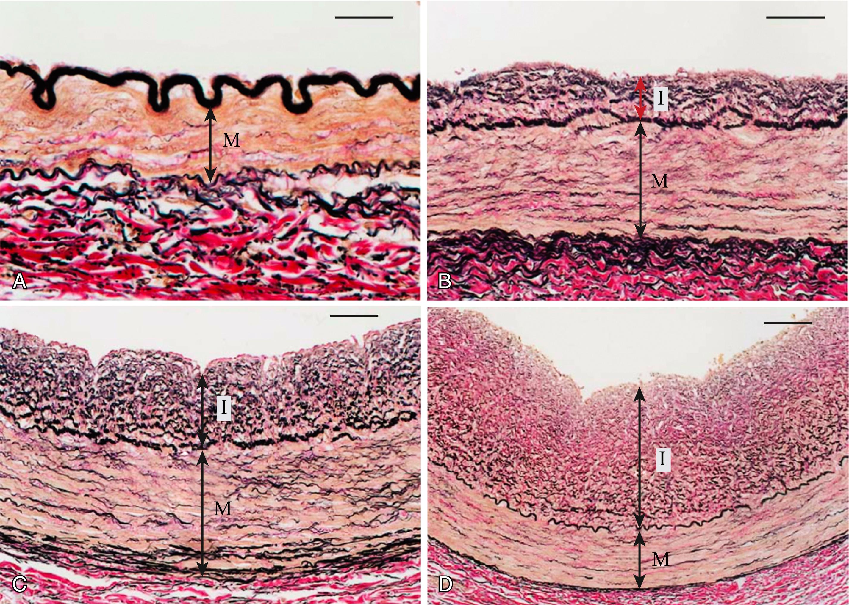 FIGURE 24.5, Diffuse intimal thickening (DIT) in proximal coronary arteries. A, Right coronary artery (RCA) of a 7-day-old girl. B, Left anterior descending artery (LAD) of a 5-year-old girl. C, LAD of a 15-year-old girl. D, LAD of a 29-year-old woman. Bars in parts A, B, C, and D represent 25, 50, 50, 100 μm, respectively. I, intima; M media.