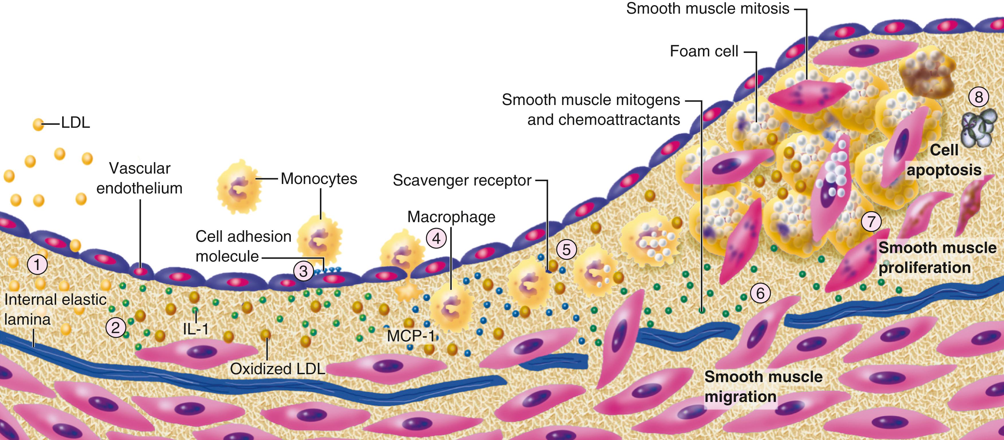 FIGURE 24.6, Schematic of the evolution of the atherosclerotic plaque. 1, Accumulation of lipoprotein particles in the intima ( yellow spheres ). The modification of these lipoproteins is depicted by the darker color . Modifications include oxidation, glycation, and aggregation. 2, Oxidative stressors, including products found in modified lipoproteins, can induce local cytokine elaboration ( green spheres ). 3, The cytokines thus induced increased expression of adhesion molecules ( blue stalks on endothelial surface ) for leukocytes that cause their attachment and chemoattractant molecules that direct their migration into the intima. 4, Blood monocytes, on entering the artery wall in response to chemoattractant cytokines such as monocyte chemoattractant protein 1 ( MCP-1 ), encounter stimuli such as macrophage colony-stimulating factor that can augment their expression of scavenger receptors. 5, Scavenger receptors mediate the uptake of modified lipoprotein particles and promote the development of foam cells. Macrophage foam cells produce mediators, such as additional cytokines and effector molecules such as hypochlorous acid, superoxide anion (O 2 − ), and matrix metalloproteinases. 6, Smooth muscle cells (SMCs) migrate into the intima from the media. 7, SMCs can then divide and elaborate the extracellular matrix, promoting ECM accumulation in the growing atherosclerotic plaque. In this manner, the fatty streak can evolve into a fibrofatty lesion. 8, In later stages, calcification can occur ( not depicted ) and fibrosis continues, sometimes accompanied by SMC death (including programmed cell death or apoptosis), yielding a relatively acellular fibrous capsule surrounding a lipid-rich core that also may contain dying or dead cells and their detritus. IL, Interleukin; LDL, low-density lipoprotein.