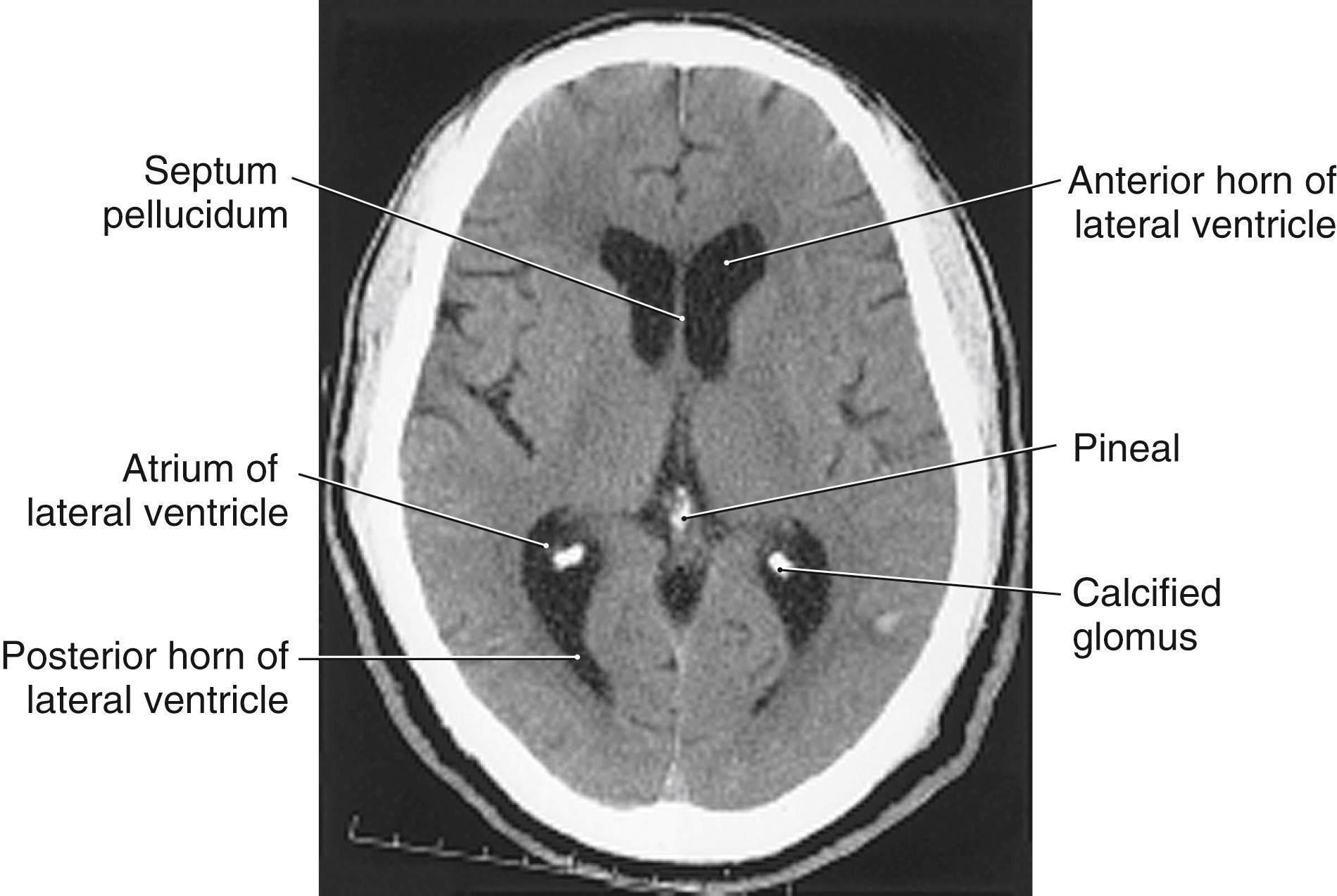 Fig. 6.5, Computed tomography scan showing a calcified glomus in a 66-year-old man. Note that calcifications are also present in the pineal in this patient. These calcifications form a triangle, the shape of which may be altered by changes in brain shape or by midline shift secondary to some pathologic process.