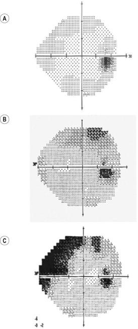 Figure 35.4, A gray scale representation of static perimetry test results obtained for ( A ) a normal visual field, ( B ) generalized or widespread visual field loss, and ( C ) localized visual field loss.