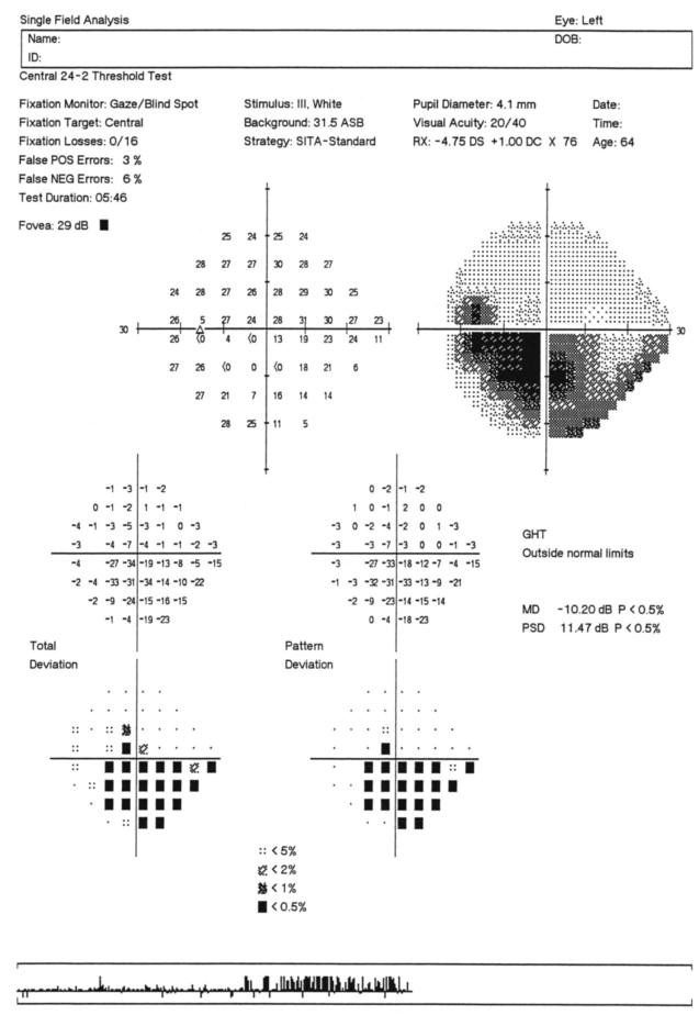 Figure 35.6, Standard Automated Perimetry (SAP) results using the SITA Standard 24-2 test procedure on the Humphrey Field Analyzer for the left eye of a patient with primary open angle glaucoma, depicting an inferior arcuate visual field defect. Note that eye alignment, as indicated by the gaze tracking presentation, became variable towards the end of the test procedure.