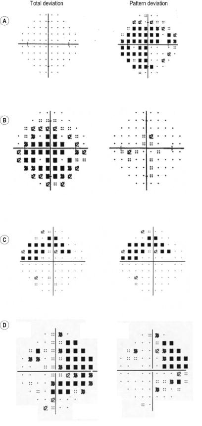 Figure 35.8, Examples of the results for Total and Pattern Deviation probability plots for ( A ) a “trigger happy” patient with abnormally high sensitivity related to pressing the response button too often, ( B ) generalized or widespread visual field loss, ( C ) localized visual field loss, and ( D ) mixed localized and widespread visual field loss. Note that these data representations provide highly useful clinical information.
