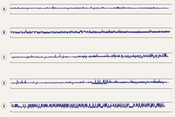 Figure 35.9, Examples of gaze tracking results for the Humphrey Field Analyzer. Upward deflections indicate alignment difficulties (eye and head movements) and downward deflections indicate blinking or droopy eyelid: ( A ) good gaze tracking, ( B ) excessive blinking, ( C ) droopy eyelid, ( D ) fatigue, and ( E ) alignment problems.