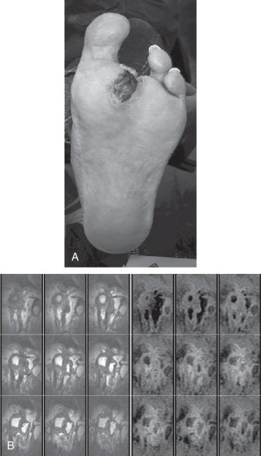 FIG 63.4, (A) A foot with a superficial ulcer needs further diagnostic studies to determine its depth. (B) Magnetic resonance imaging scan of the foot can show the depth of the wound and evidence of osteomyelitis when it is not clinically apparent.