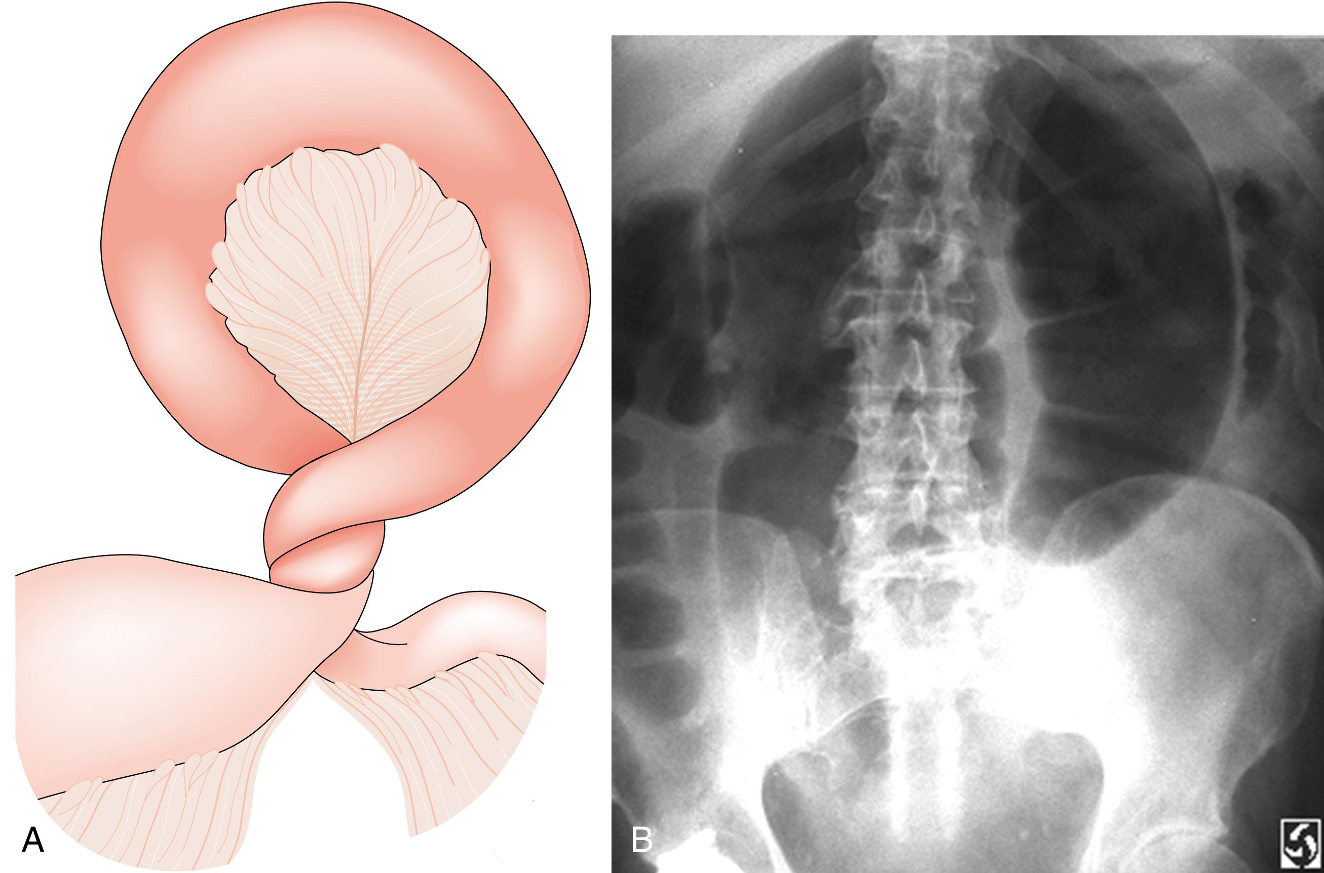 Fig. 13.2, Volvulus: an example of closed-loop obstruction.