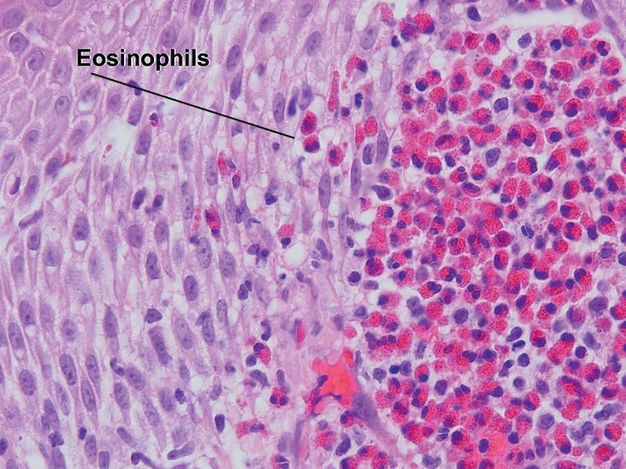 Fig. 1.11, Eosinophilic spongiosis, incontinentia pigmenti