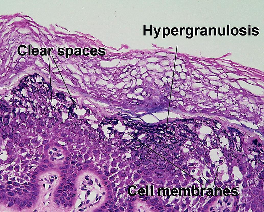 Fig. 1.12, Epidermolytic hyperkeratosis