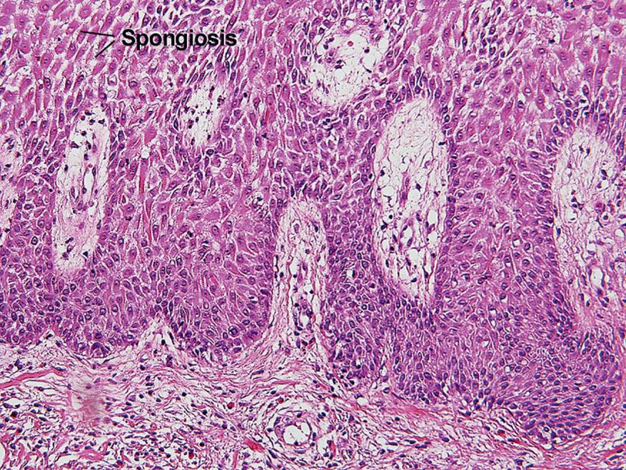 Fig. 1.14, Lymphocyte exocytosis, subacute spongiotic dermatitis