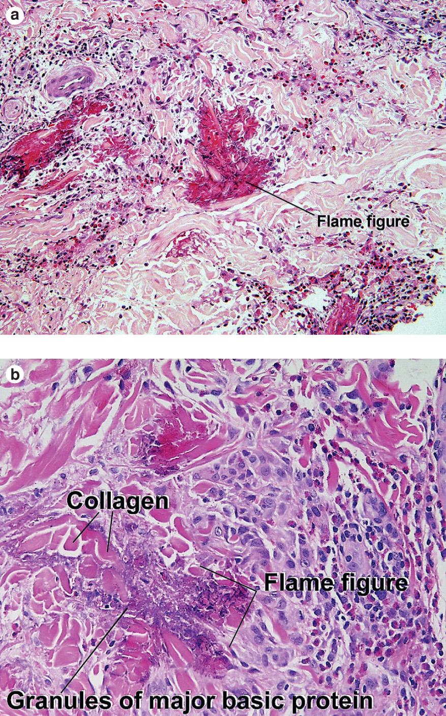 Fig. 1.15, Flame figure, Wells syndrome