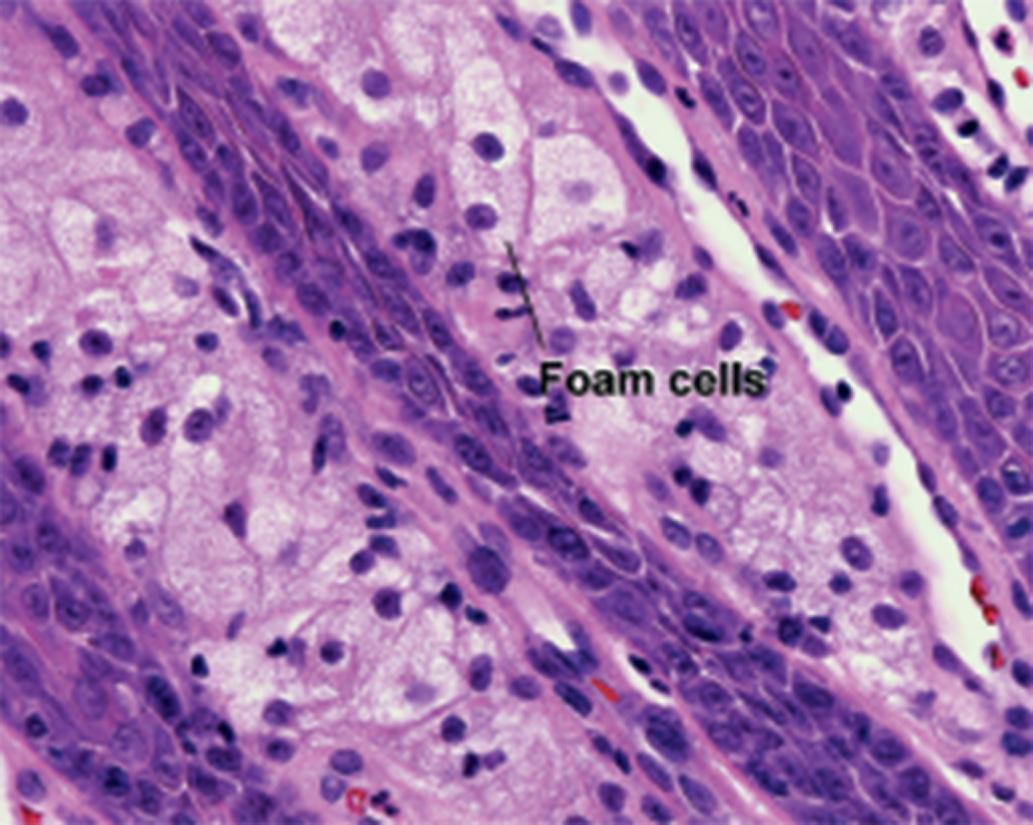 Fig. 1.16, Foam cells, verruciform xanthoma