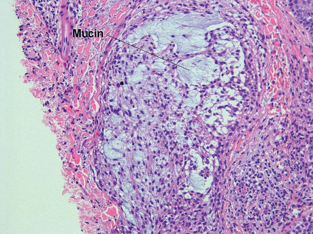 Fig. 1.17, Follicular mucinosis, alopecia mucinosis