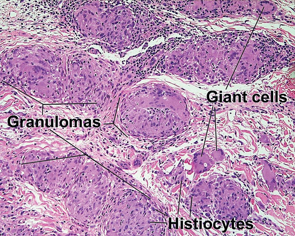 Fig. 1.18, Granulomas, sarcoid