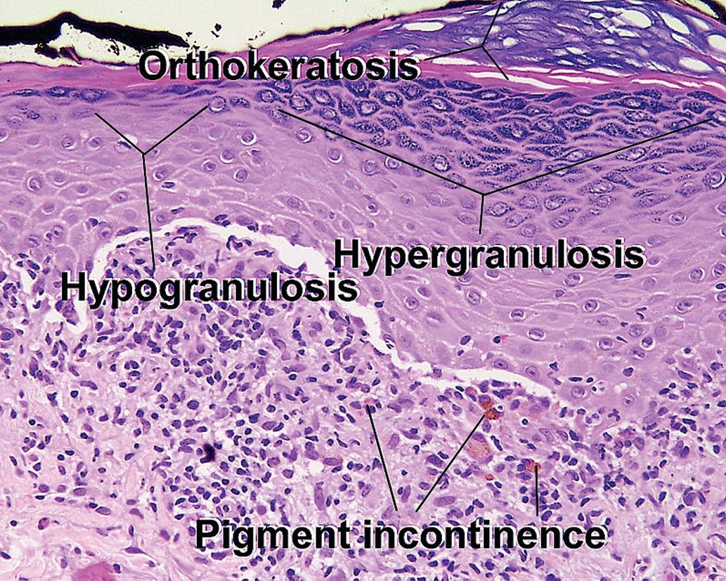 Fig. 1.19, Hypergranulosis/hypogranulosis, lichen planus