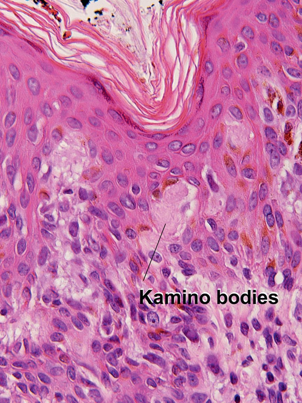 Fig. 1.20, Kamino bodies, Spitz nevus