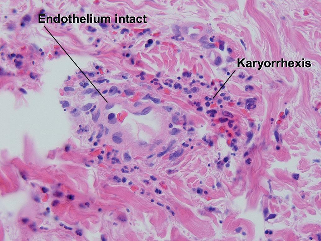 Fig. 1.21, Karyorrhexis, leukocytoclastic vasculitis