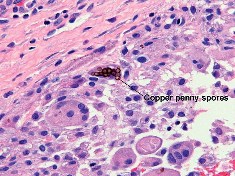 Fig. 1.23, Medlar bodies, chromomycosis