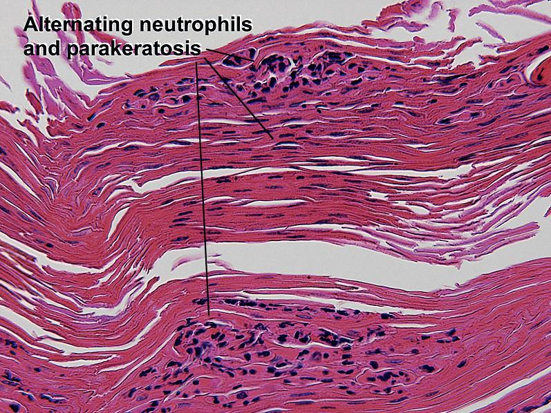 Fig. 1.24, Munro microabscess, psoriasis