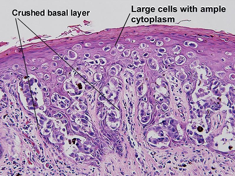 Fig. 1.26, Pagetoid cells and pagetoid scatter, Paget disease