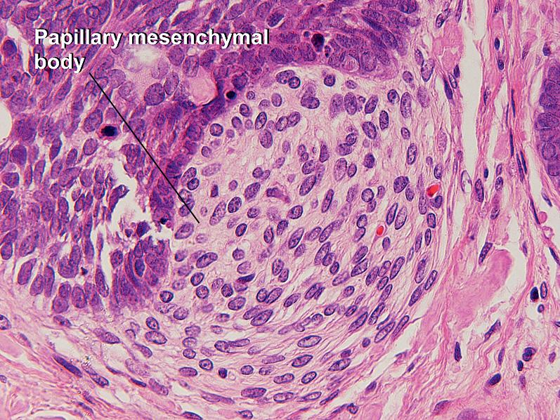 Fig. 1.28, Papillary mesenchymal body, trichoepithelioma